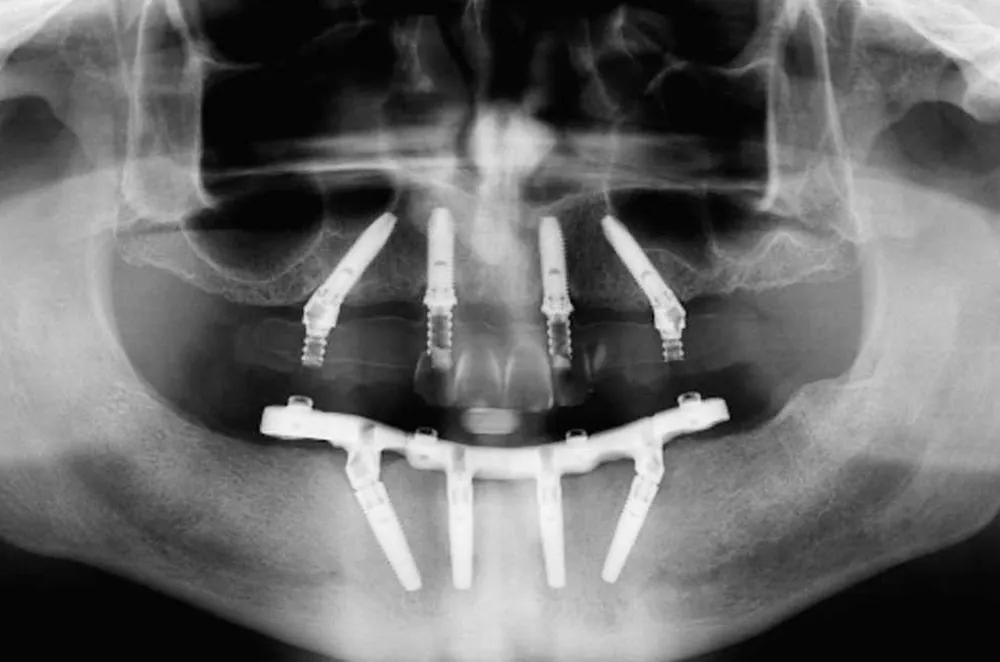 Röntgenbeispiel mit vier Implantaten pro Kiefer