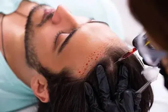 Nel trapianto capelli bisogna separare il modo in cui i graft vengono prelevati dal modo in cui vengono inseriti.